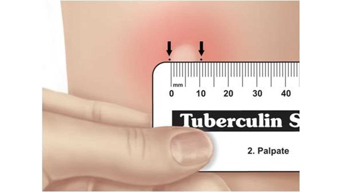 tb test form printable