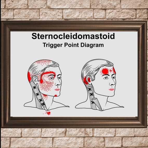 printable trigger points chart